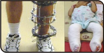 Physiotherapy